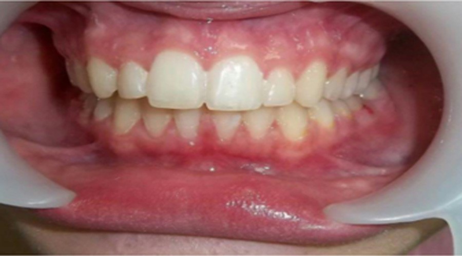 بعد تقويم وعلاج الاسنان بمركز دكتور ايمن الغمراوى -تركيب وتجميل الاسنان 1